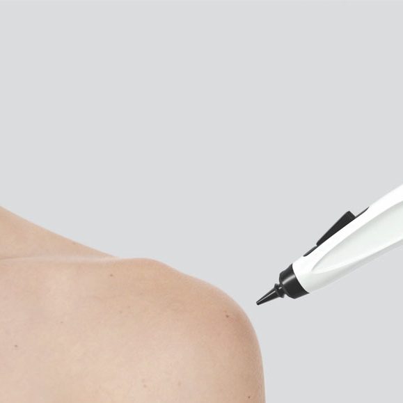 brooke-nix-cryocorrect-treatment