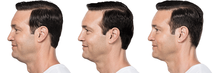 Kybella image 2
