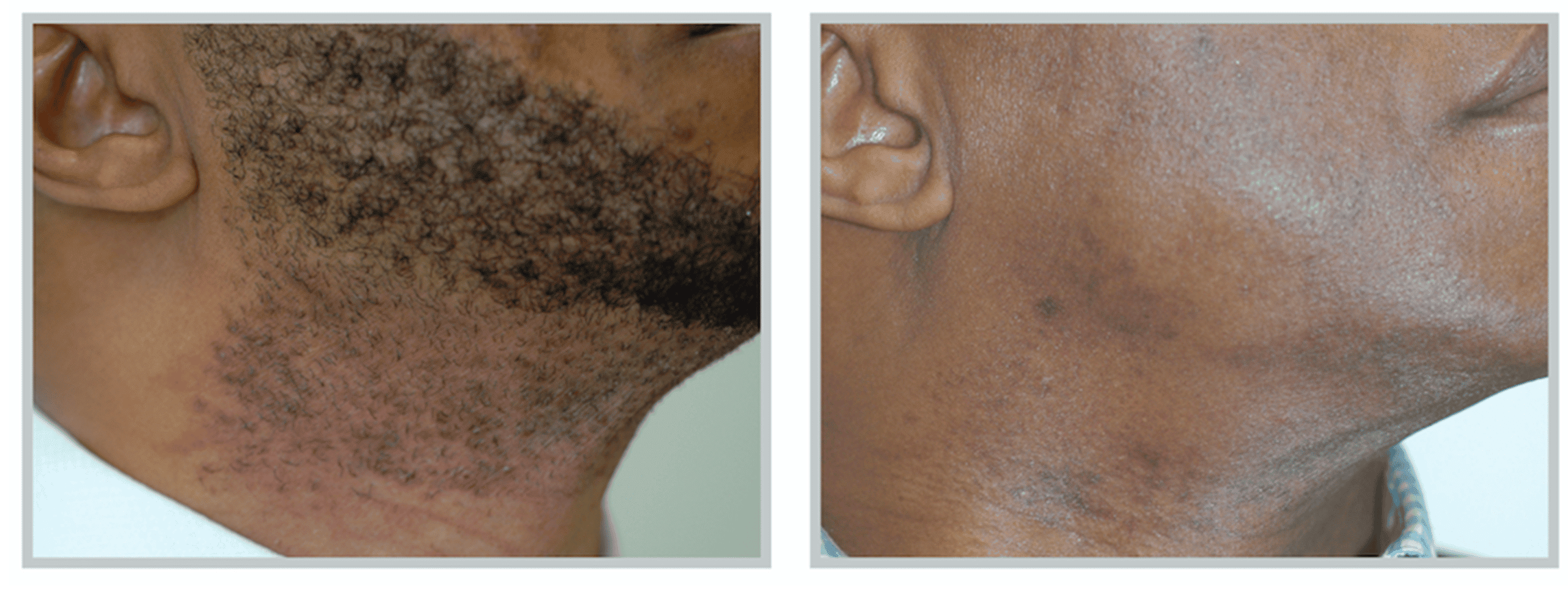 Laser Hair Removal B&A