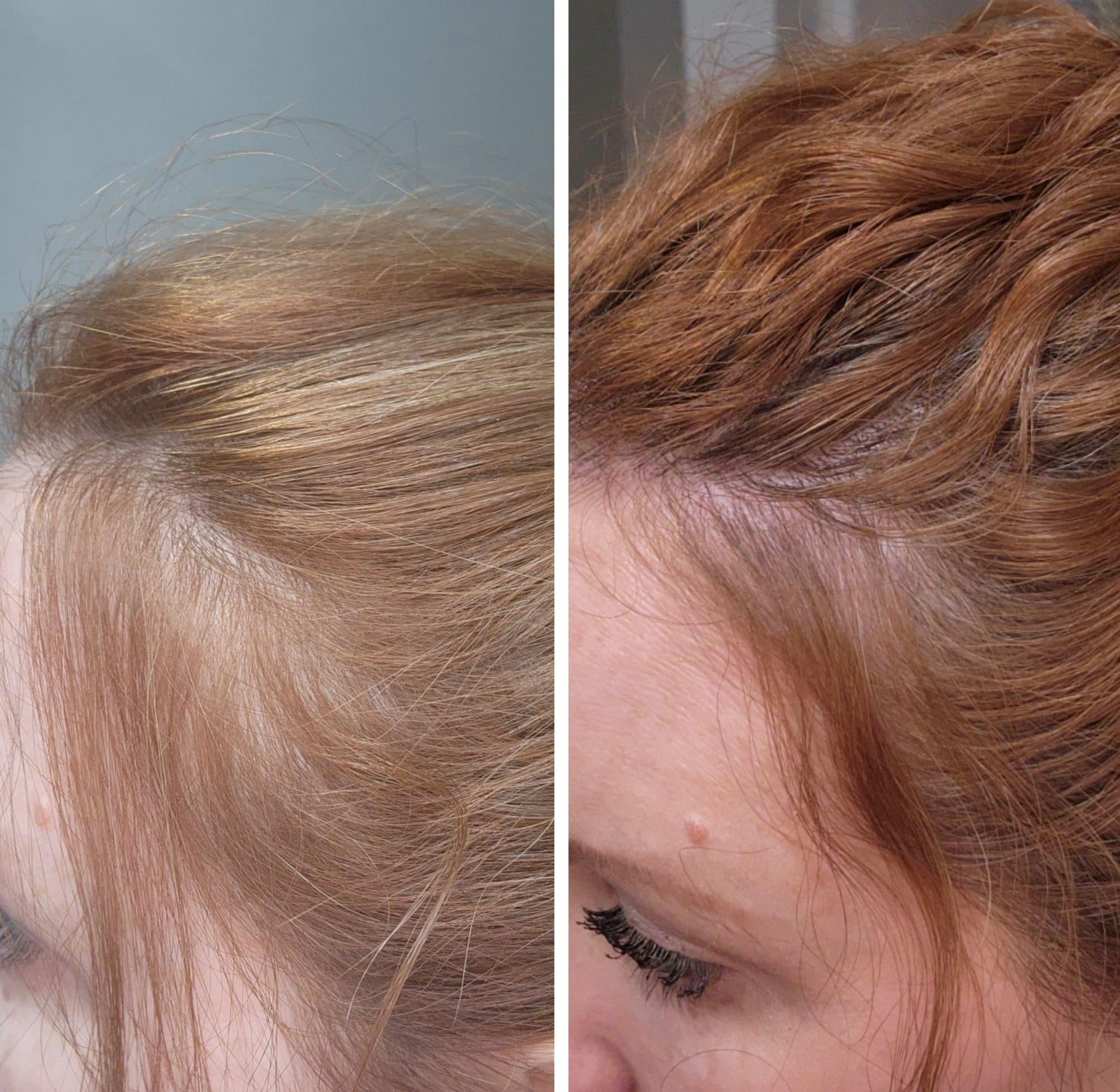 Nutrafol B&A 2