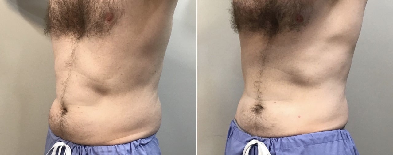 coolsculpt b and a
