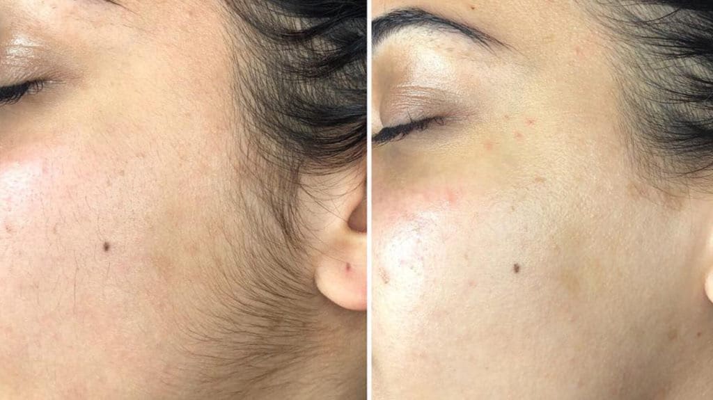 derm before and after